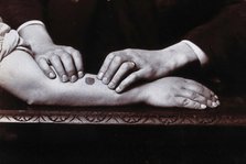 Two hands held on either side of a dark mark on a forearm, to demonstrate...., c1920s. Creator: Unknown.