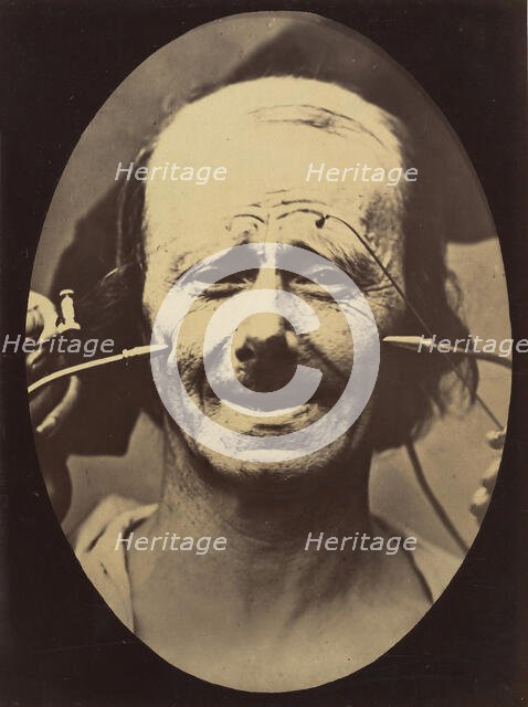 Figure 34: Grimace, 1854-56, printed 1862. Creators: Duchenne de Boulogne, Adrien Alban Tournachon.