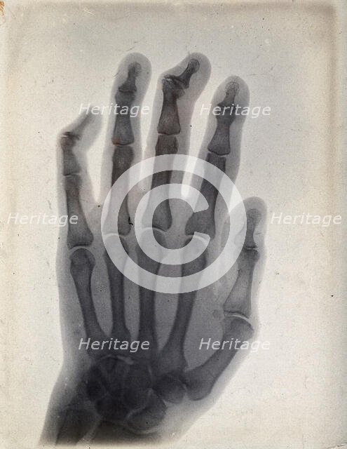 The bones of a hand, viewed through x-ray, 1895.