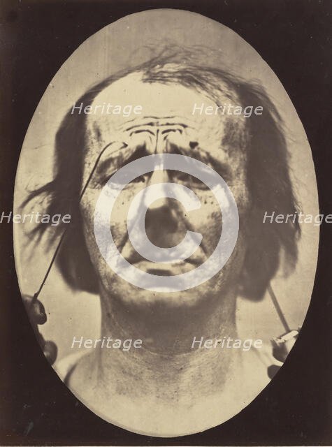 Figure 20: Profound suffering, with resignation, 1854-56, printed 1862. Creators: Duchenne de Boulogne, Adrien Alban Tournachon.