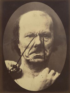 Figure 18: Aggression, wickedness, 1854-56, printed 1862. Creators: Duchenne de Boulogne, Adrien Alban Tournachon.