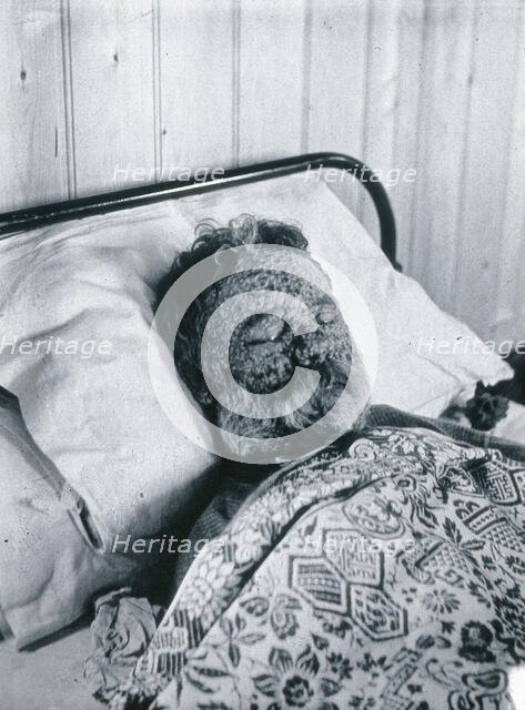 Gloucester smallpox epidemic, 1896: George Steel as a smallpox patient, 1896. Creator: HCF of Gloucester.