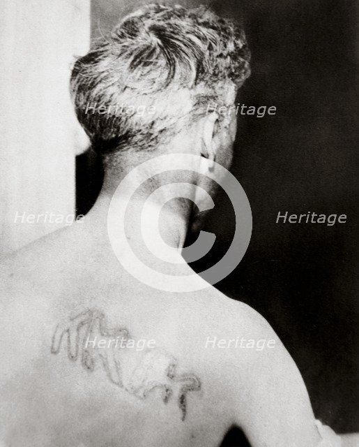 The branded back of Reverend Orrin Van Loon, Detroit, Michigan, USA, July 1924. Artist: Unknown