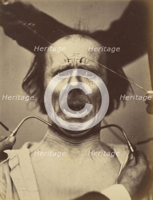 Icono-photographique. Mécanisme de la Physionomie Humaine. Fig. 65, 1854-56, printed 1862. Creators: Duchenne de Boulogne, Adrien Alban Tournachon.