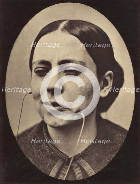 Figure 36: Scornful laughter and scornful disgust, 1854-56, printed 1862. Creators: Duchenne de Boulogne, Adrien Alban Tournachon.