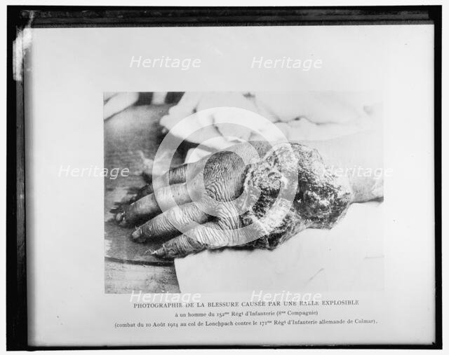 Photographie de la blessure causée par une balle explosible..., 1914. Creator: Harris & Ewing.