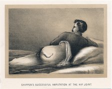'Shippen's Successful Amputation at the Hip Joint', American Civil War, 1865. Artist: Unknown