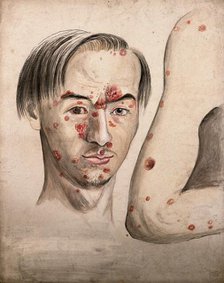 Head of a man with a severe disease affecting his face; and a section of diseased arm, 1800-1899. Creator: Christopher D'Alton.
