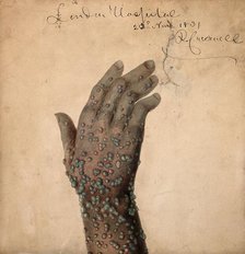 Rash of pustules on the hand of a patient, probably suffering from smallpox, 1831. Creator: Robert Carswell.
