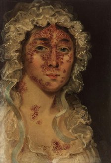 Mrs Bennett, afflicted with a skin disease, between 1818 and 1821. Creator: Unknown.