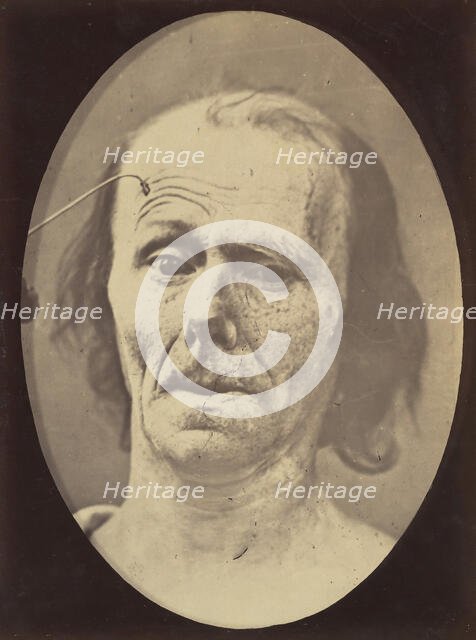 Figure 9: A study of m. frontalis in maximum contraction, 1854-56, printed 1862. Creators: Duchenne de Boulogne, Adrien Alban Tournachon.