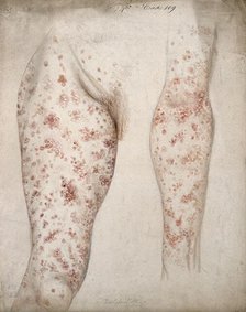 Sores and diseased skin on the leg and arm of a woman, 1856. Creator: Christopher D'Alton.