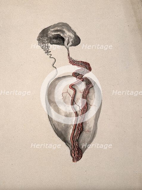 A diseased part of the body. Creator: Unknown.