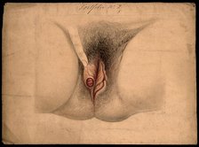 Female genitalia held open by a finger to show an area of diseased tissue, (18)66. Creator: Christopher D'Alton.