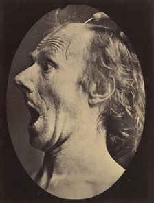 Figure 57: Astonishment, stupefaction, amazement, 1854-56, printed 1862. Creators: Duchenne de Boulogne, Adrien Alban Tournachon.