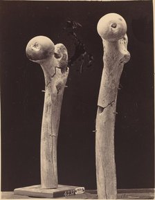 Specimens of Gunshot Fractures of the Femur, c. 1867. Creator: Unknown.