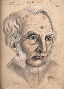 A man suffering from chancre of the lip, displaying scar tissue on his lower lip, forehead..., 1867. Creator: Christopher D'Alton.