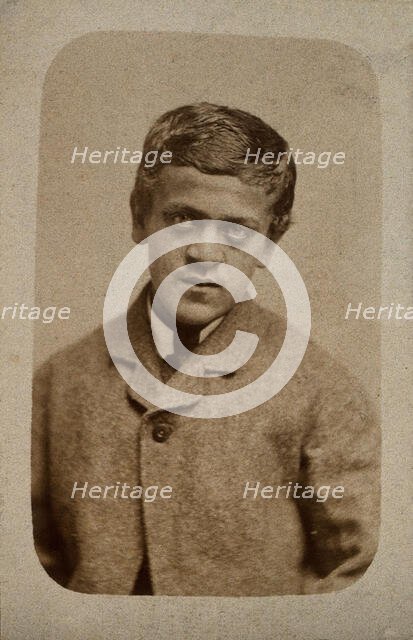 A young man, probably showing some signs of Down's syndrome, c1880s. Creator: Davis & Sons.