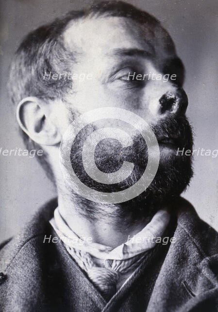 Friern Hospital, London: a man's face showing tuberculosis of the skin (lupus vulgaris), 1890/1910. Creator: Unknown.