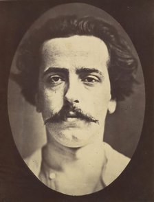Figure 4: The face in repose of a young man , 1854-56, printed 1862. Creators: Duchenne de Boulogne, Adrien Alban Tournachon.