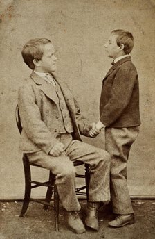 Down's syndrome: in two young men holding hands, one sitting and one standing, c1880s. Creator: Unknown.