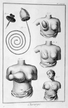 Breast surgery, 1751-1777. Artist: Unknown