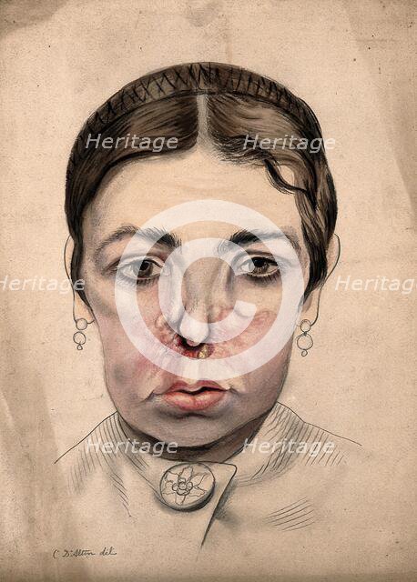 Head of a girl with a severe disease affecting her nose, 1869. Creator: Christopher D'Alton.