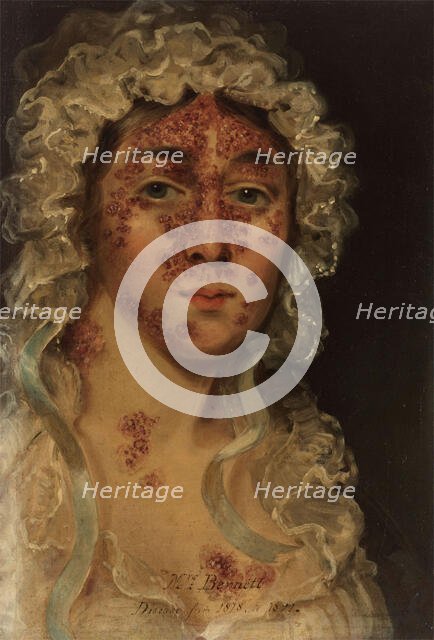 Mrs Bennett, afflicted with a skin disease, between 1818 and 1821. Creator: Unknown.