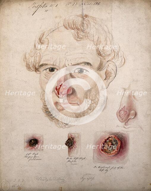 Head of a man with a severe disease affecting his nose; a detail of the nose..., 1800-1899. Creator: Christopher D'Alton.