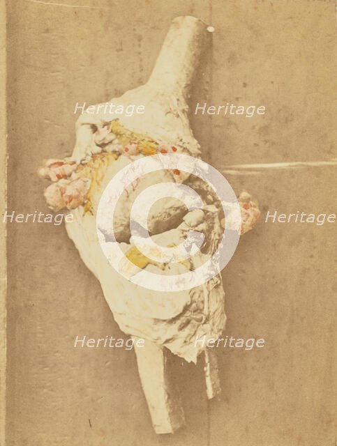 Arthropathie du genou, chez une ataxique (lésions anatomiques), 1871. Creator: Arthur de Montmeja.