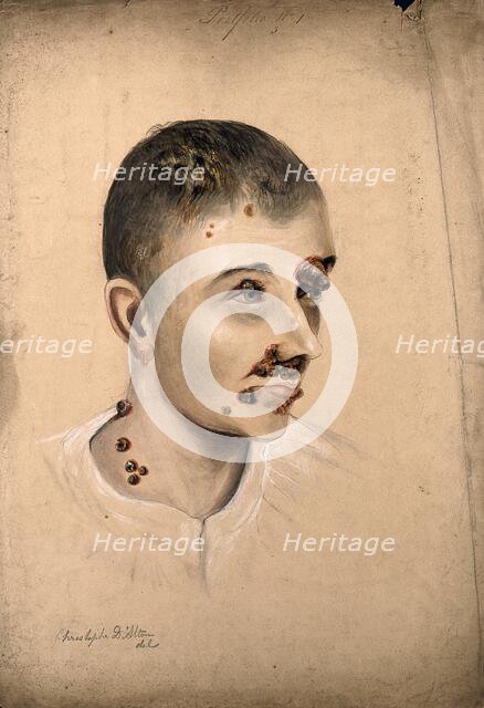 Head of a woman with a severe disease affecting her face and neck, 1864. Creator: Christopher D'Alton.