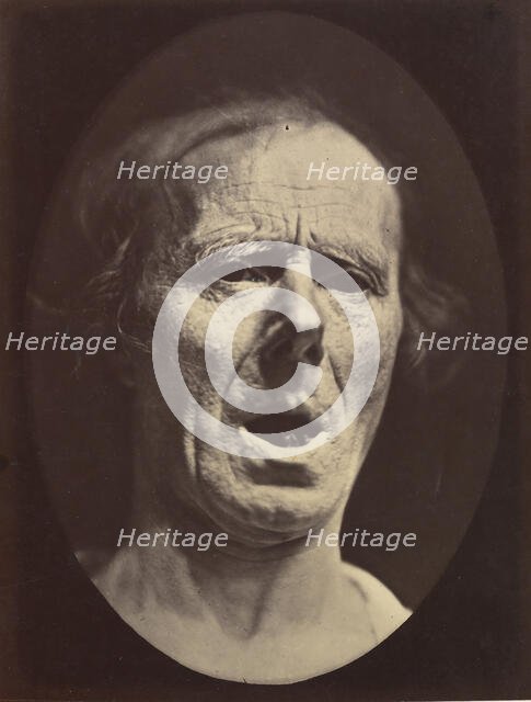 Figure 54: Voluntary lowering of the lower jaw, 1854-56, printed 1862. Creators: Duchenne de Boulogne, Adrien Alban Tournachon.