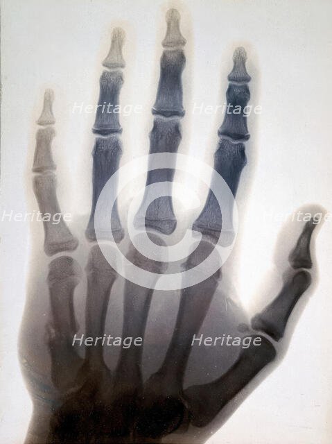 Sir Gervas Powell Glyn, 6th Bart: radiograph of his hand, 1896. Creator: Sir GP Glyn.