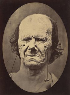 Figure 47: A suggestion of this same weeping, 1854-56, printed 1862. Creators: Duchenne de Boulogne, Adrien Alban Tournachon.