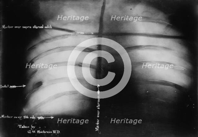 X-Ray of Roosevelt [shows bullet], 1912. Creator: Bain News Service.
