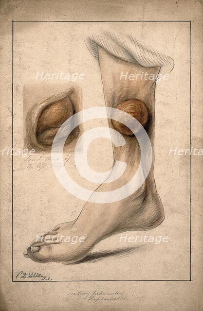 Tertiary tubercular elephantiasis on the thigh and calf of a woman, 1874. Creator: Christopher D'Alton.