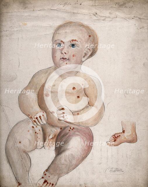 A three month old baby boy with diseased skin and sores on his face and body..., between 1800 & 1899 Creator: Christopher D'Alton.
