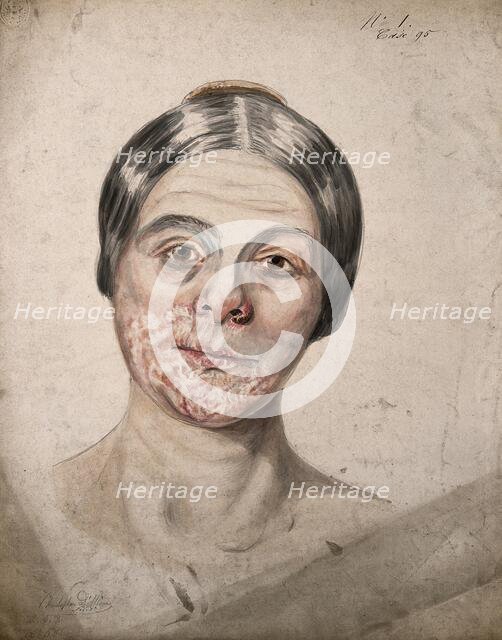 Head of a woman with a severe disease affecting her face, 1800-1899. Creator: Christopher D'Alton.