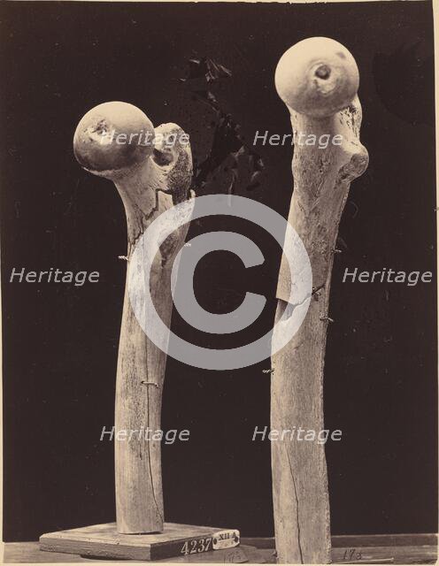 Specimens of Gunshot Fractures of the Femur, c. 1867. Creator: Unknown.