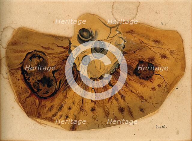 A section of diseased intestine or heart, 1800-1850. Creator: Richard Bright.