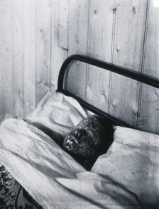 Gloucester smallpox epidemic, 1896: Kate Mills, a smallpox patient, 1896. Creator: HCF of Gloucester.