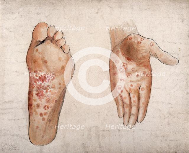 Diseased tissue on the palm of the hand and sole of the foot of a man, (1853?). Creator: Christopher D'Alton.