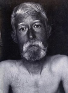 Friern Hospital, London: a patient, facing forwards, 1890/1910. Creator: Unknown.