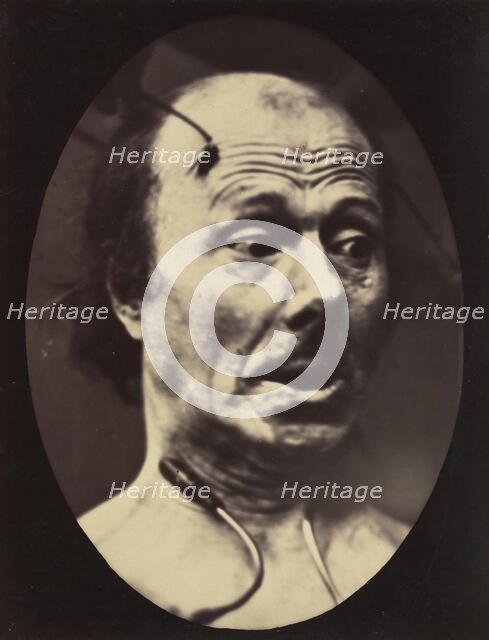 Figure 60: Fright, 1854-56, printed 1862. Creators: Duchenne de Boulogne, Adrien Alban Tournachon.