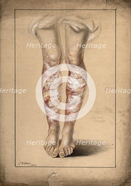 Diseased skin on the legs of a man suffering from psoriasis, 1873. Creator: Christopher D'Alton.