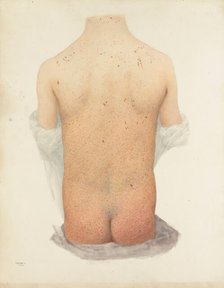 Back of a boy with skin disease, 1891. Creator: W Toogood Hill.