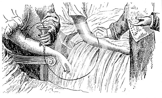 Blood transfusion, c1880. Artist: Unknown