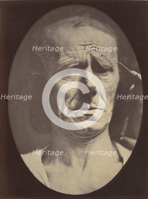 Figure 22: No painful expression , 1854-56, printed 1862. Creators: Duchenne de Boulogne, Adrien Alban Tournachon.