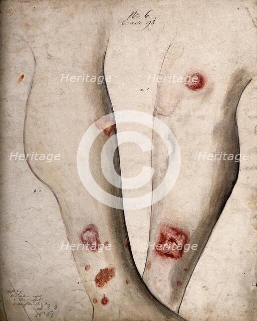Sores and areas of diseased skin on the lower legs of a boy, between 1800 and 1899. Creator: Christopher D'Alton.
