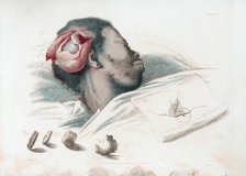 View of wound in skull after trephination and removal of shattered bone piece at bottom left, 1821. Artist: Thomas Landseer